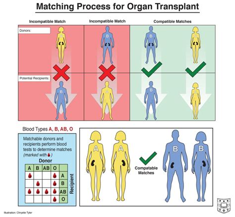 How Kidney Allocation Changed in 2021 | Department of Surgery | Washington University in St. Louis