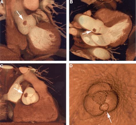 Figure 1 from Papillary Fibroelastoma of the Aortic Valve: Appearance in 64-Slice Spiral ...