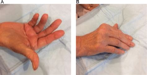 Palmar Fibromatosis Ultrasound