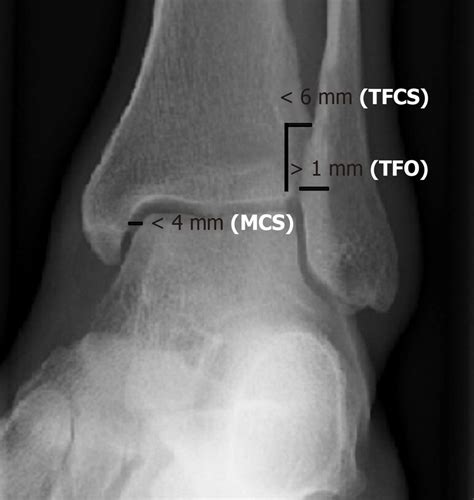 Normal values of tibiofibular clear space, tibiofibular overlap and... | Download Scientific Diagram