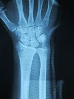 Radius Styloid Process Fractures Treated with Break-Away Screws: Two Cases Report