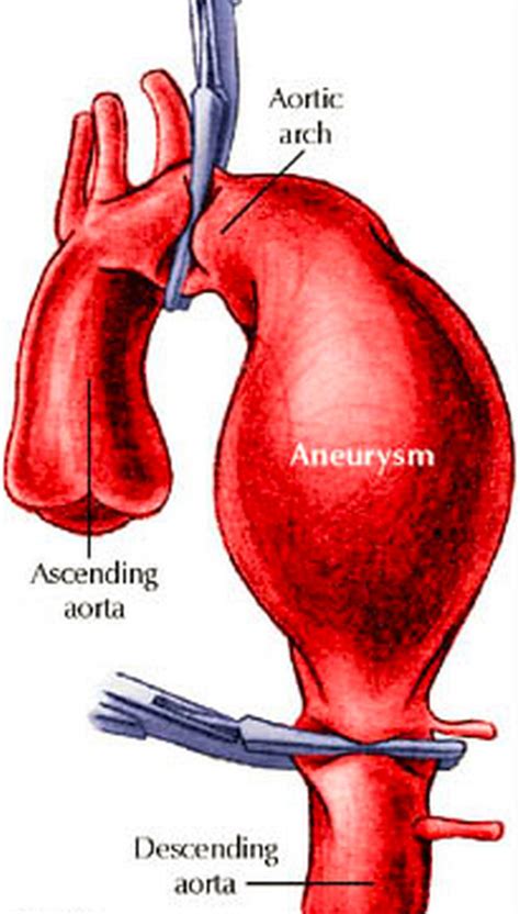 Marfan Syndrome Pictures