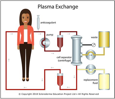 Therapeutic Plasma Exchange as a Treatment for Systemic Sclerosis - Scleroderma Education Project