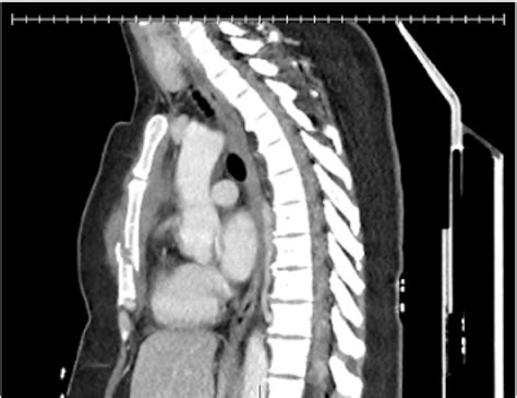 CT chest of sternal fracture. CT imaging demonstrating our patient's... | Download Scientific ...