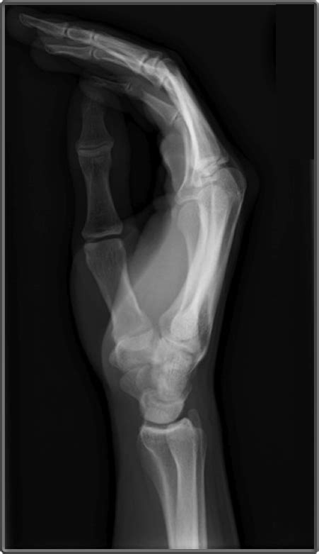 Clinical Anatomy | Radiology | Lateral Hand