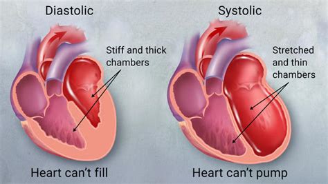 Congestive Heart Failure Explained - Central Georgia Heart Center