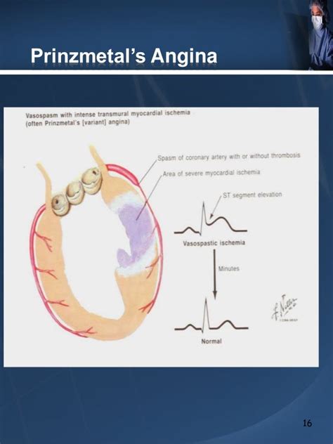 The Use of EKG to Detect Coronary Ischemia