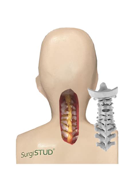 Chin-On-Chest Deformity 1 - SurgiSTUD