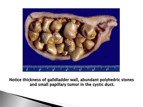 Chronic cholecystitis