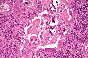 Serous carcinoma of the endometrium - Libre Pathology