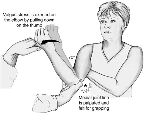 Figure 2 from Ulnar collateral ligament injury in the overhead athlete: diagnosis and treatment ...