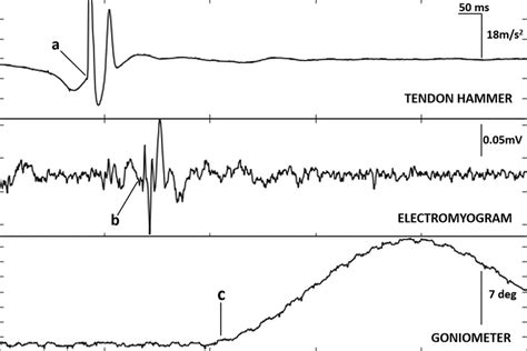 Recording of the myotatic reflex in session 1 of electromyogram (EMG ...