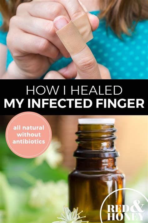 How I Healed My Infected Finger without Antibiotics | Natural treatments, Essential oils herbs ...