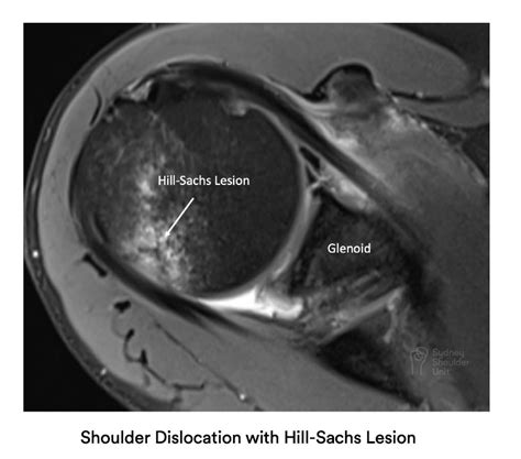 Mri Shoulder Labrum Tear