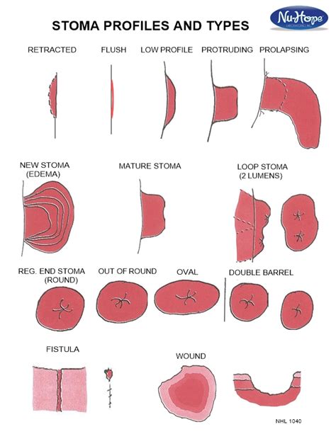 Stoma Types