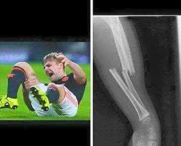 Psv Luke Shaw Injury : Luke Shaw Could Miss Start Of Next Season ...