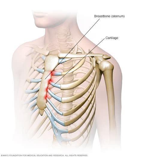 Le syndrome - Origine Tietze