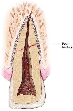 Root-Fracture - American Association of Endodontists