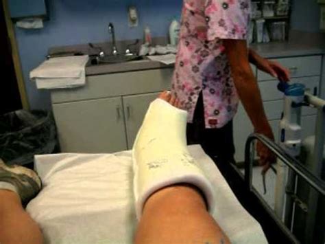 Trimalleolar Fractures and Dislocated Ankle (1st cast removal) - YouTube