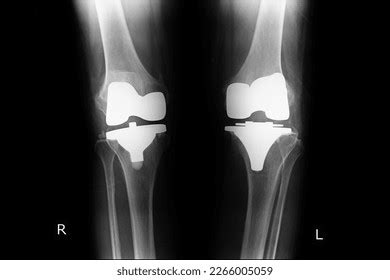 Total Knee Replacement Both Knee Stock Photo 2266005059 | Shutterstock