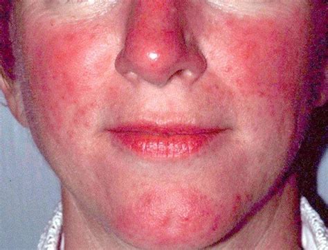 Lupus or Rosacea? Test May Mislead | Rosacea.org