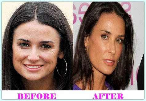 Demi Moore Plastic Surgery