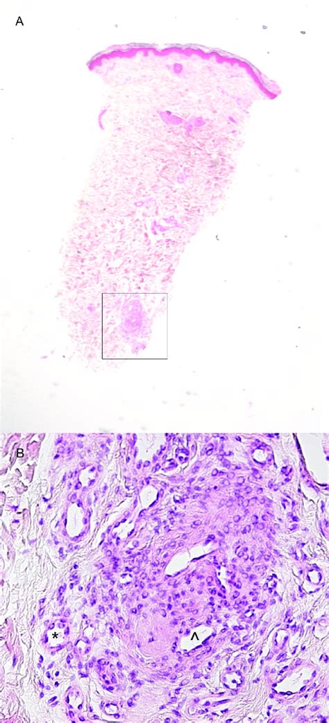 Example two of a probable occlusive microangiopathy. (A) Low ...