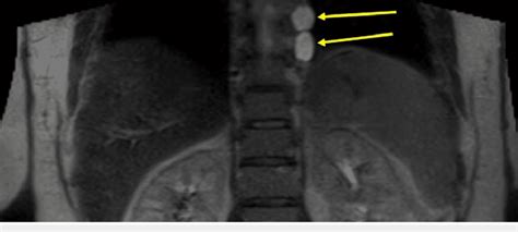 Full-body MRI showing nerve sheath tumors on the left from levels T4 to... | Download Scientific ...