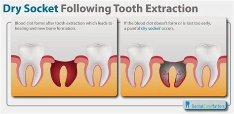 Home Remedies For Dry Socket - TZ Health