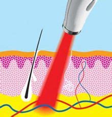 IPL vs Laser - A Guide to Understanding Light Treatments in 2020 | Laser skin treatment, Ipl ...