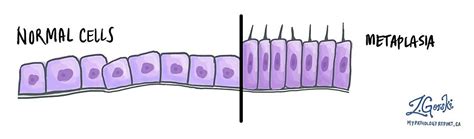 Metaplasia | MyPathologyReport.ca