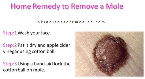 Remove a Mole at Home with Apple Cider Vinegar - Skin Disease Remedies