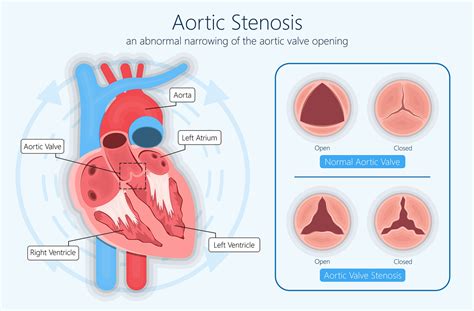 Aortic Valve Stenosis : Symptoms, Diagnosis, Treatment in Hyderabad