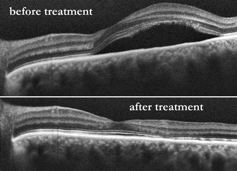 Central Serous Retinopathy (CSR): Symptoms and Treatment Options