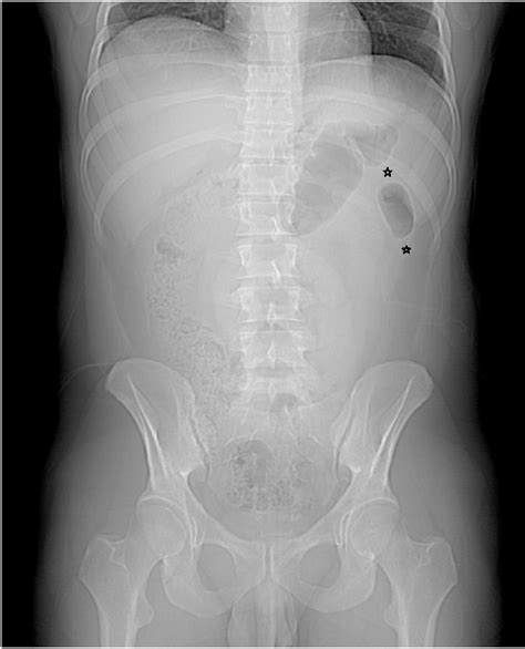 Figure 2 from A variation of colon cut off sign in acute pancreatitis ...