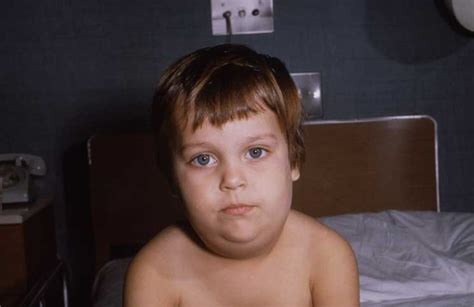 The Signs, Symptoms, and Prevention of Mumps – Is the MMR / Mumps ...