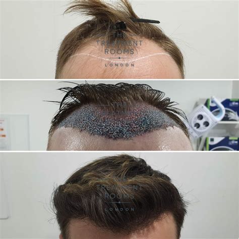 Unshaven FUE Hair Transplant (UFUE) | The Treatment Rooms London