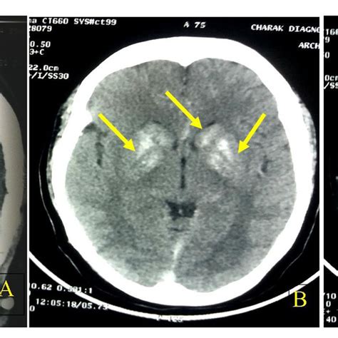 Basal Ganglia Calcification Mri