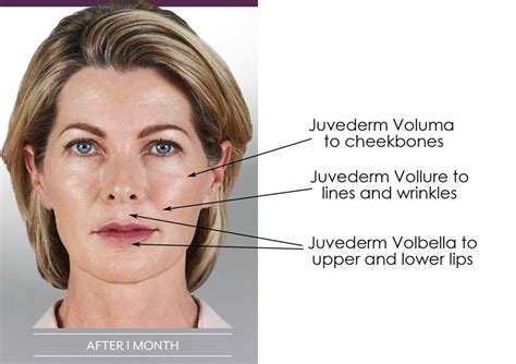 Your Guide to Juvederm Types: Voluma, Volbella & Vollure