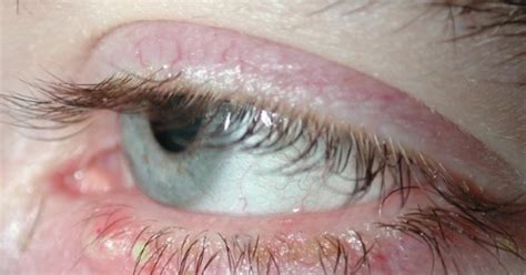 Eyelid Infection