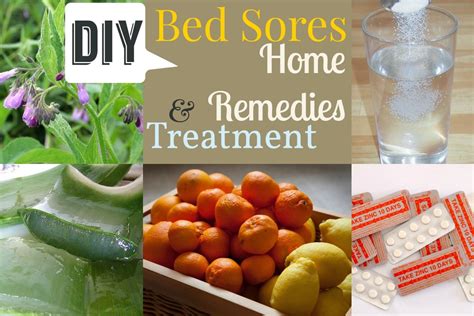 Bed Sores Remedies You Need to Know | Bed sores, Remedies, Soreness