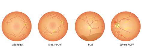 The 4 Stages of Diabetic Retinopathy | Bellport/Coram Perspective Eye ...