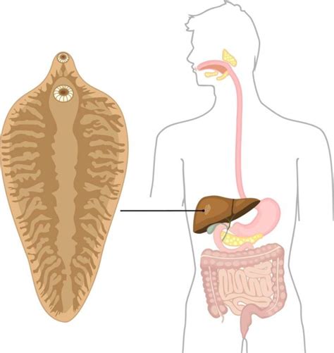 Liver Flukes Treatment & Symptoms To Look Out For - Page 3 of 7 - A2Z Healthy