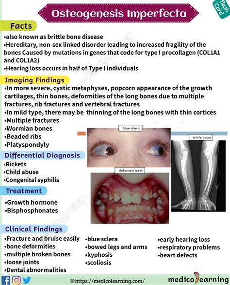 Osteogenesis imperfecta – MedicoLearning