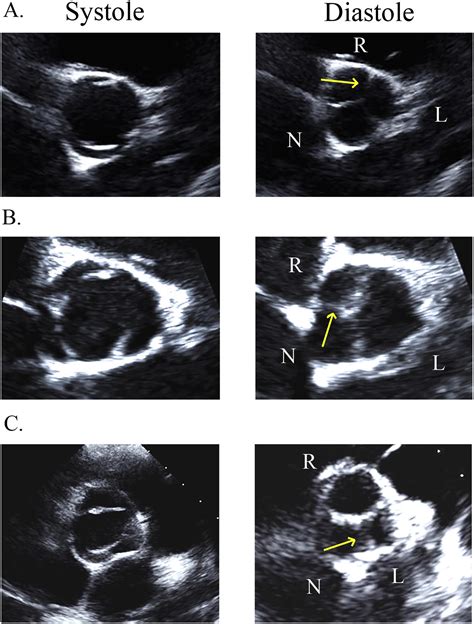 Characteristic Morphologies of the Bicuspid Aortic Valve in Patients with Genetic Syndromes ...