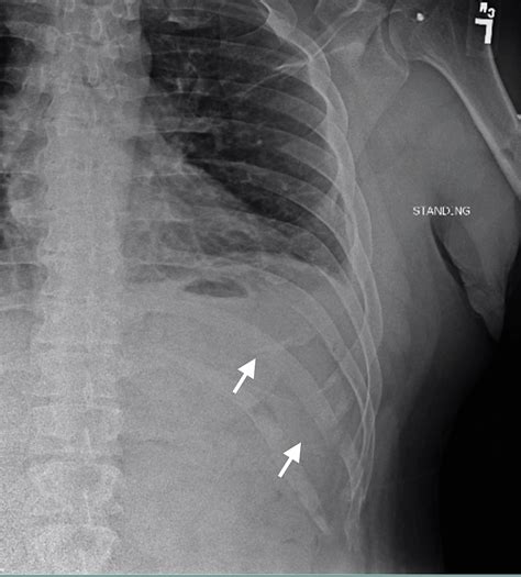 Outpatient Surgery for Rib Fracture Fixation: A Report of Three Cases | Cureus