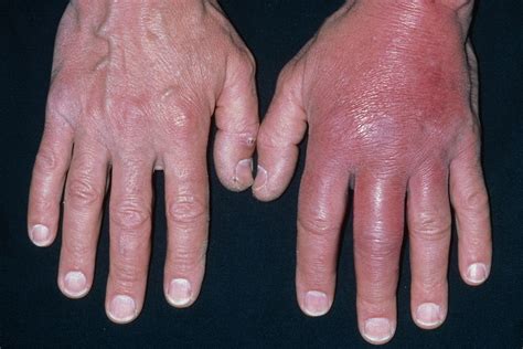 Cellulitis - NHS