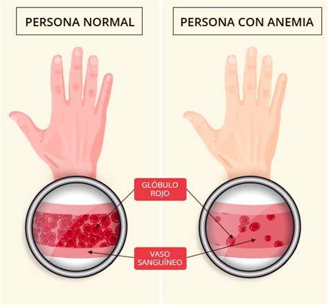 Anemia ferropénica | Fátima Branco Parra