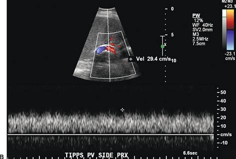 Ultrasound Hepatopetal Flow