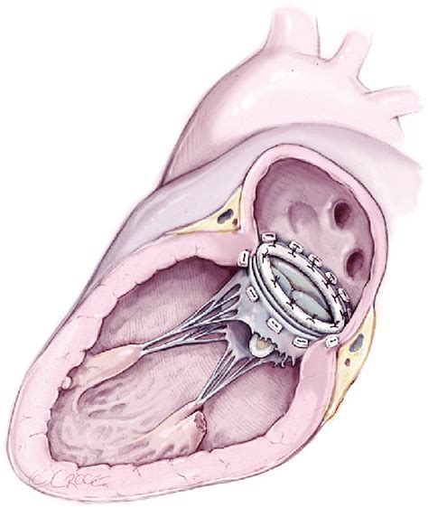 Mitral valve replacement by biological prosthesis implantation. | Download Scientific Diagram